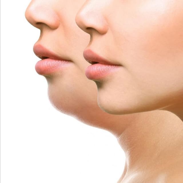 Double Chin Treatment at Project360 Aesthetics in Pearland, TX